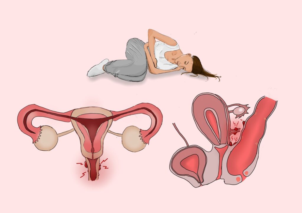 HEMPEARTH - The Benefits Of Psychedelics And High THC Cannabis Oil For Endometriosis 3 endometriosis article
